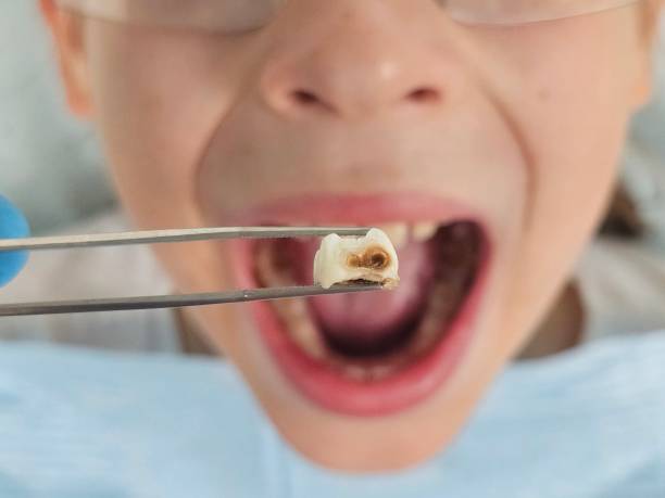 Best Emergency Dental Extractions in Bowling Green, FL